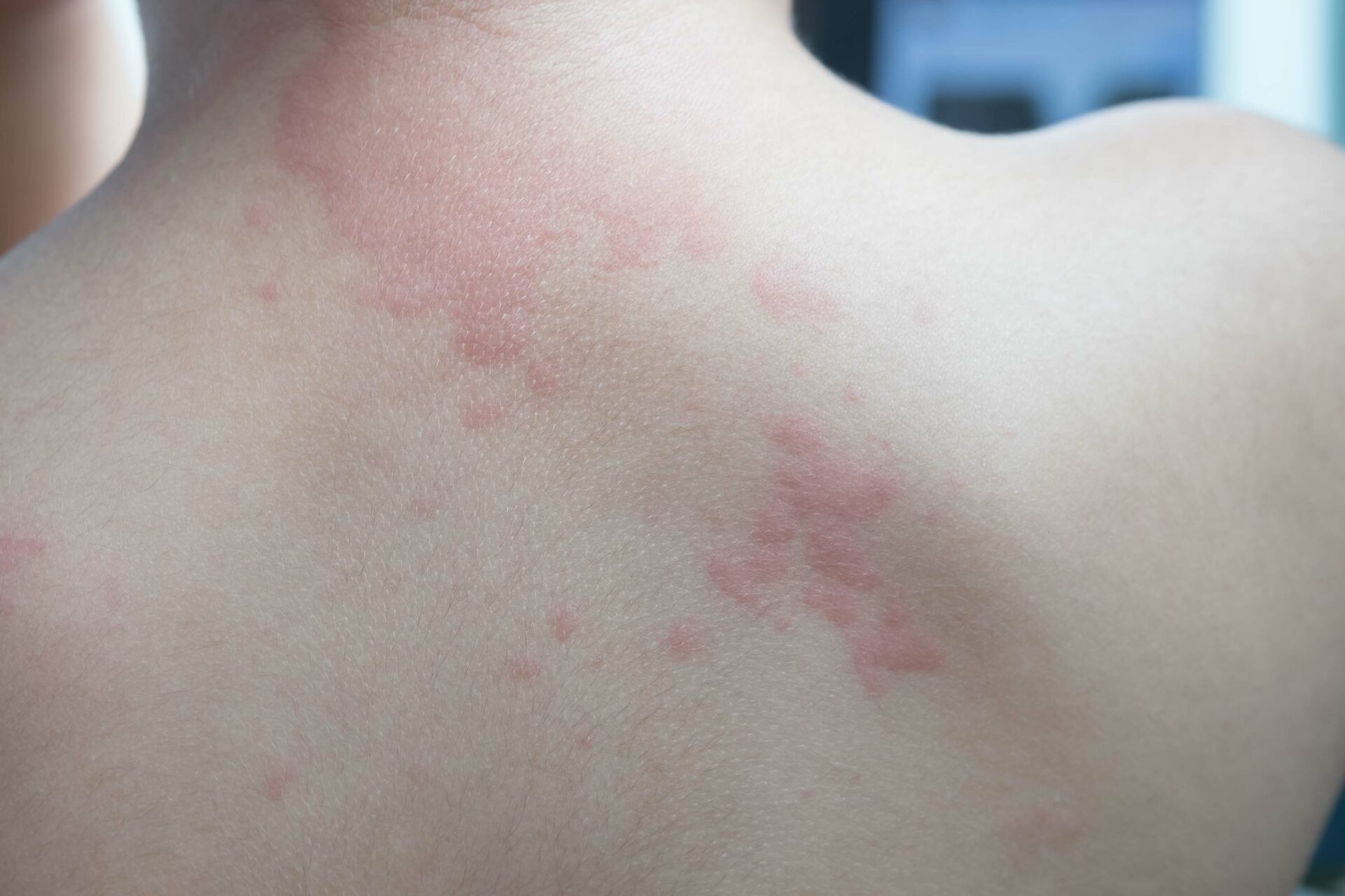 【画像】蕁麻疹の症状